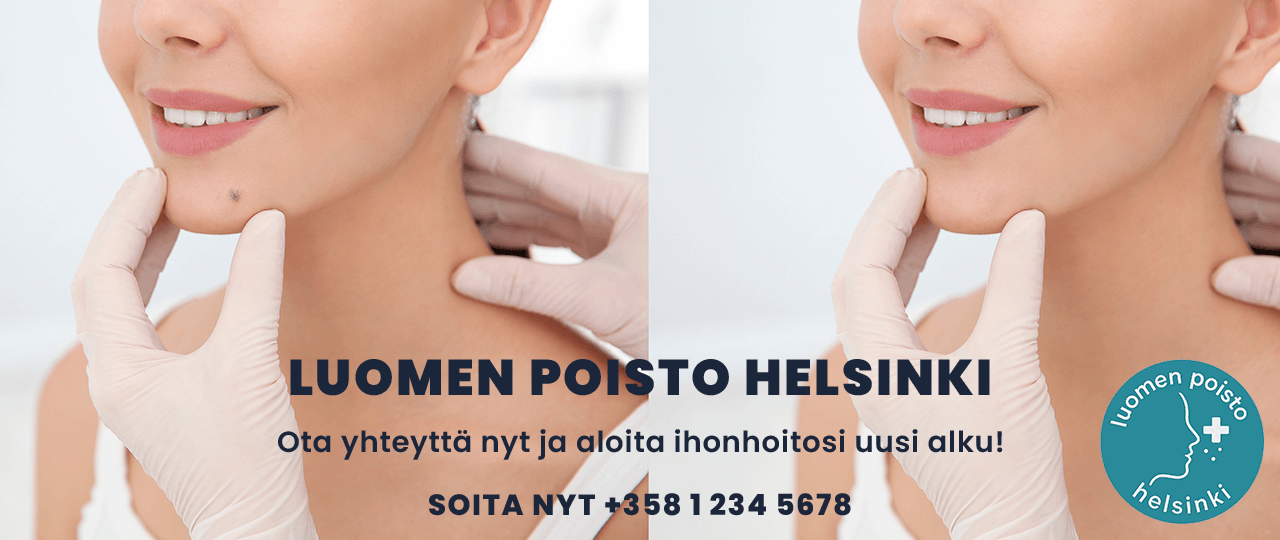 Luomen Poisto Helsinki