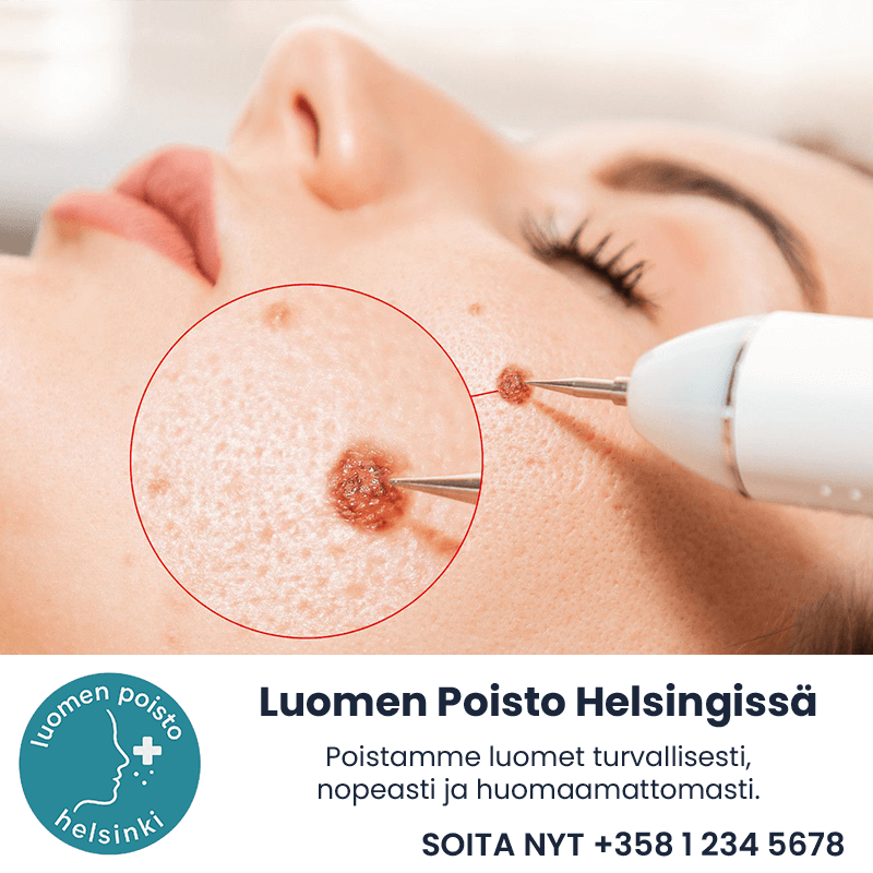 Luomen Poisto Helsingissä